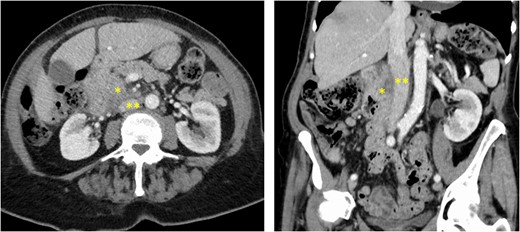 Preoperative CT-scan showing a huge duodenal mass (*) of 7 cm in size developed from the second part of the duodenum, close to the anterior wall of the infrarenal IVC (**).