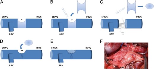 (A) We performed a pancreaticoduodenectomy with en-bloc resection of a 3 cm² area of the anterior wall of the IVC (*). Direct suture of the IVC was not possible and venous reconstruction required the interposition of a graft. (B) Since the posterior wall of the IVC is usually more floppy than the anterior one because of its longer distance from the renal veins, we harvested a transversal patch of 20 × 30 mm in size from the posterior wall of the IVC, below the confluence with the renal veins. (C) Reconstruction of the posterior wall of the IVC was achieved by a direct hand-sewn hemi-circumferential anastomosis using a single-layer non-absorbable 4/0 polypropylene. (D and E) The transversal venous patch was placed longitudinally on the resected area at the anterior wall of the IVC (**), and was sutured using a single-layer non-absorbable 4/0 polypropylene. (F) Intraoperative view showing the venous autoplasty of the IVC. SRIVC, suprarenal inferior vena cava; IRIVC, infrarenal inferior vena cava; RRV, right renal vein; LRV, left renal vein.
