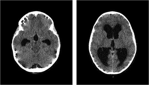 CT scan of the brain showed acute hydrocephalus with massive dilatation of lateral and third ventricles (at mesencephalon and thalamus levels, respectively).