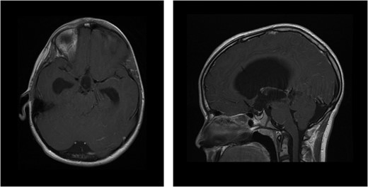 MRI of brain enhanced with contrast agent showing ventricular dilatation with aqueducts occlusion (axial and sagittal sequences, respectively).