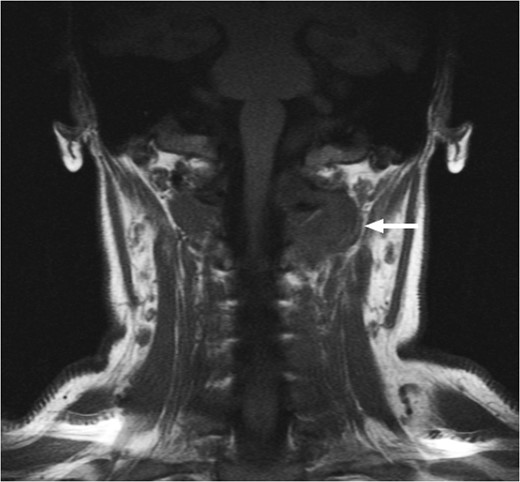 T1-weighted MRI showing the lesion in the posterosuperior aspect of the left neck arising at the level of C1, eroding through the C1 vertebra and displacing the thecal sac.