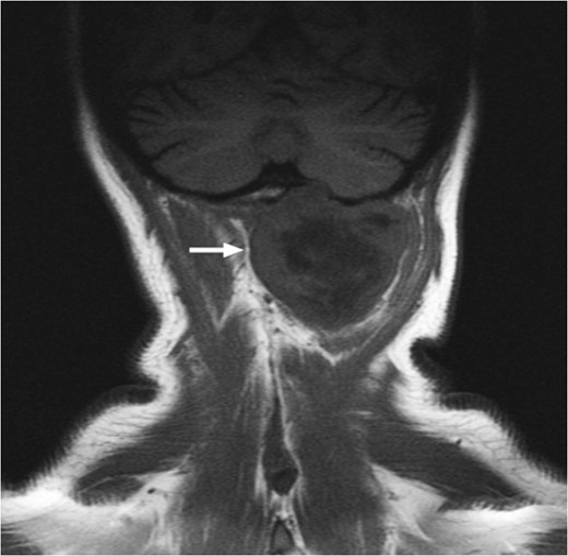 T1-weighted MRI showing the lesion eroding through the left basioccipital skull, impinging the dura overlying the left cerebellum.