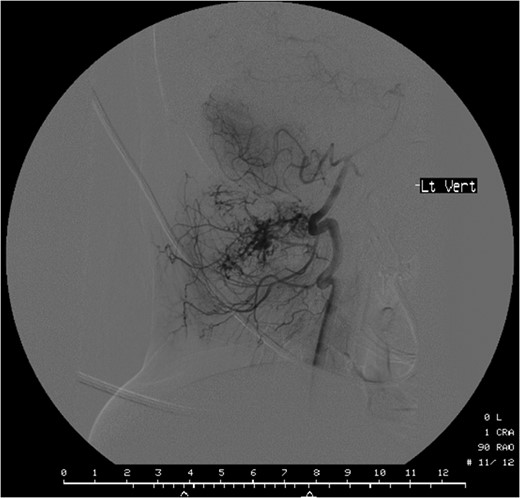 Computed tomographic angiography of the left vertebral artery showing the tumour deriving its vascular supply from the cervical and muscular branches of the artery.
