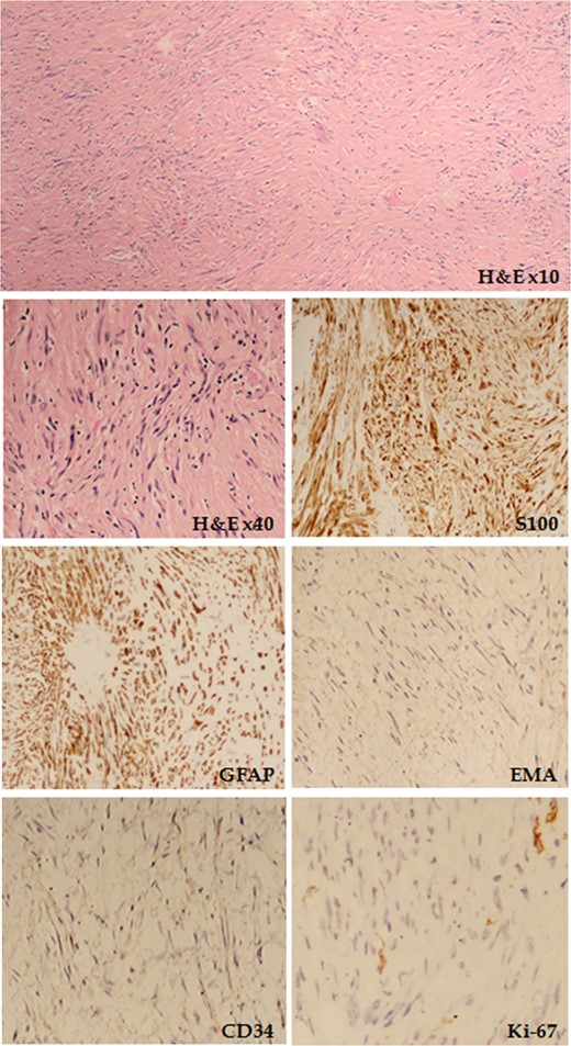 Haematoxylin and eosin (H&E) staining showing spindle-shaped cells organized in whorls and fascicles is shown, together with the tumour immunoprofile for S100, GFAP, epithelial membrane antigen (EMA), CD34 and Ki-67.