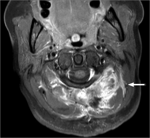 T1-weighted MRI scan showing the presence of scar tissue at the previous tumour site 6 months post-operatively. There is no evidence of residual tumour.