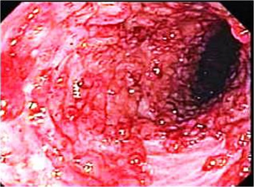 Endoscopic picture showing markedly elevated erythmatous mucosal surface with bleeding and erosions.