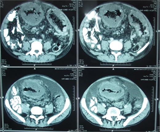 Postcontrast axial images of the abdomen showing irregular wall thickening involving the distal desceding colon, sigmoid colon and rectum without significant luminal narrowing. Heterogenous enhancement of the thickened bowel wall with mild pericolic fat stranding.