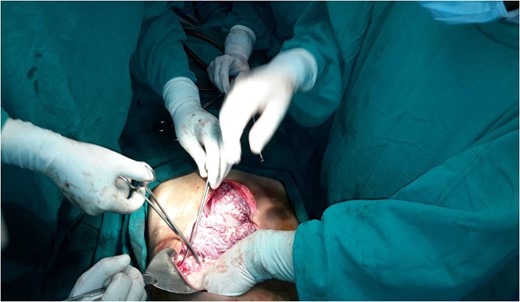 Operation theater picture showing elevated bluish surfaces due to vascular malformation.