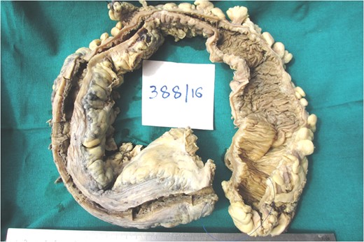 Picture showing the subtotal colectomy gross specimen measuring 70 cm in length.