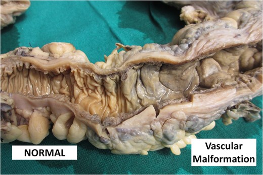 Picture showing the cut surface of the colon comparing normal pale white mucosa with dark brown thickened mucosa in vascular malformation.