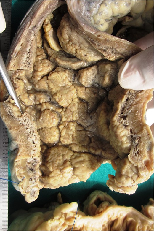 Markedly edematous and thickened mucosa due to vascular malformation.