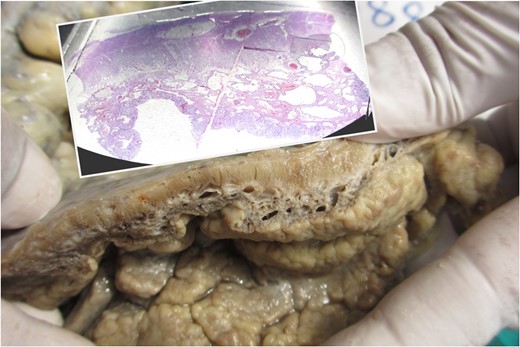 Thickened wall with tiny cystic spaces in mucosa, muscularis propria and serosa of the wall (inset: histopathological picture of the same area).