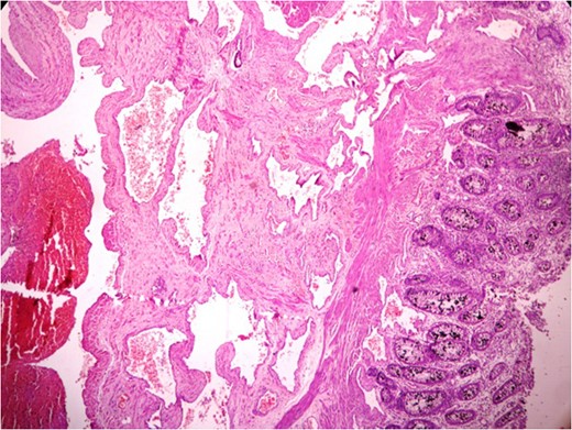 Anastomosing and dilated vascular channels in the submucosal area with congested and thrombosed blood vessels. (H&E ×400).