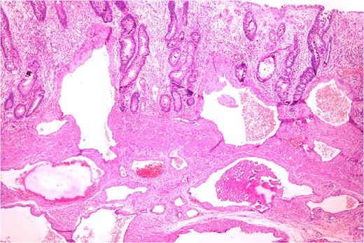 Vascular channels reaching upto the mucosa level. (H&E ×400).