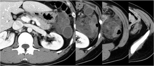Abdominal enhanced CT showing multiple cysts with inflammation in the descending mesocolon.