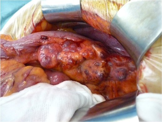 Intraoperative findings on laparotomy. Multiple blueberry-coloured cysts were identified in the descending mesocolon.