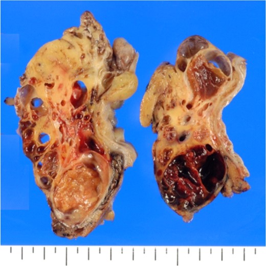Cut surfaces of the cystic lesions showing a multi-cystic space with recent haemorrhage and suppurative inflammation.