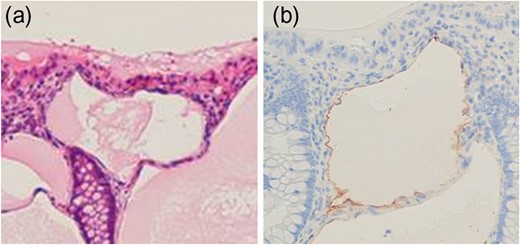 (a) Dilated tubules lined by flat cells. (b) Immunostaining for podoplanin/clone D2-40. The flat cells express podoplanin.