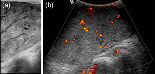 Gray-scale ultrasound shows a circumscribed, solid mass with heterogeneous internal echotextures, including hyperechoic, hypoechoic and multifocal anechoic areas, some of which were linear cleft-like in shape (a) and the color Doppler sonography demonstrates increased intralesional vascularity (b).