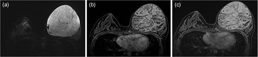 Axial STIR image of breast MRI shows a well-circumscribed mass with heterogeneous signal intensities (SIs), consisting of solid components with iso-to-high SIs, with interspersed by areas of cystic portions. These cystic areas are also noted along the periphery of the mass. Dark focal SI due to hemorrhage and signal voids due to fast flowing blood vessels are seen (a). On dynamic contrast-enhanced T1WI, the solid portions shows early intense heterogeneous enhancement on 1 min image (b) with a persistent pattern on the late phase of 5 min image after contrast administration (c).