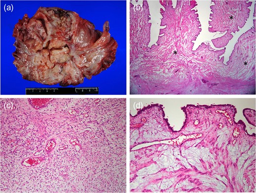 Gross specimen reveals myxoid and friable on sectioning (a). Low-power magnification demonstrates cellular stromal component and characteristic leaf-like projections into cleft-like spaces (H&E, ×10). Stromal component shows extensive myxoid change (asterisks) (b). The central non-myxoid area shows mild hypercellularity and mild nuclear atypia, typical features of benign phyllodes tumor (H&E, ×100) (c). Prominent myxoid changes of the stroma are seen in many areas (H&E, 100) (d).
