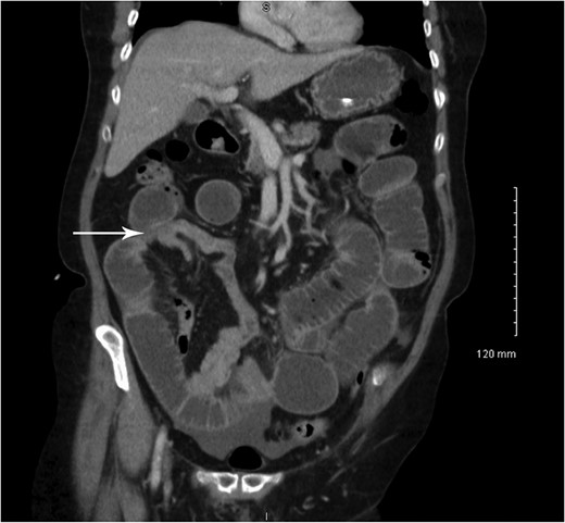 Coronal CT showing small bowel to small bowel intussusception (arrow).
