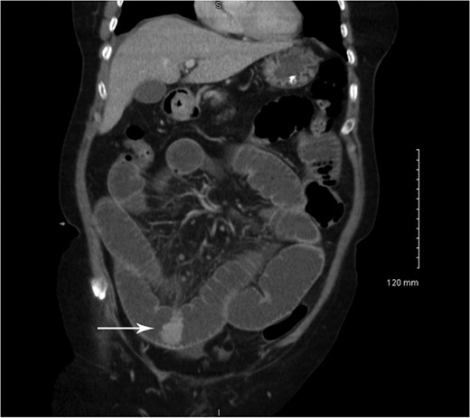 Coronal CT showing small bowel mucosal-enhancing lesion (arrow).
