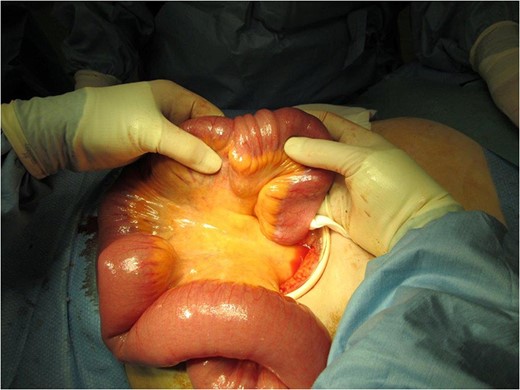 Intra-operative picture demonstrating one area of small bowel to small bowel intussusception.