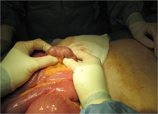 Intra-operative picture demonstrating the same area of small bowel to small bowel intussusception post manual reduction.