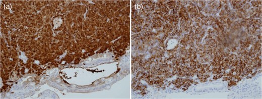 Biopsy of intestinal lead-point for intussusception demonstrating positivity for S100 (a) and melan-A (b).
