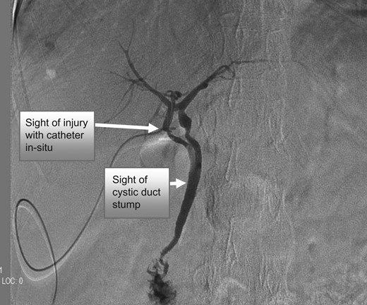 Cholangiogram showing the double duct originating from the hepatic hilus with injury on the right duct. The two ducts drain singly with cystic duct opening into the common duct.