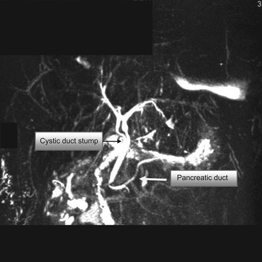 MRCP showing the double common bile duct, cystic duct stump and pancreatic duct. The cystic duct stump is noted to open distally into the common duct.