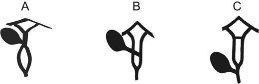 Unclassified reported variants. (A) Variant described by Paraskevas et al. and Sahu et al.(B) Variant described by Kosar et al.(C) Variant described in current report.