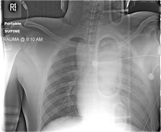 Admission AP CXR demonstrating a widened mediastinum and increased haziness of the left hemi-thorax.