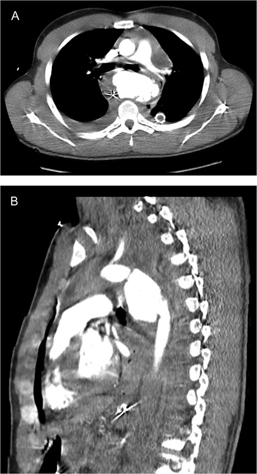CT scan images (A axial; B sagittal) demonstrating aortic rupture with active contrast extravasation at the level of the proximal descending aorta just distal to the ductus on both axial and sagittal imaging.
