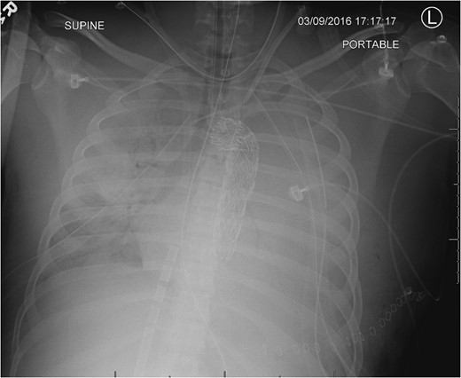 CXR following chest closure on postop day 3 demonstrated the aortic stent, multiple life support lines and bilateral lung opacification from the severe persistent respiratory failure.