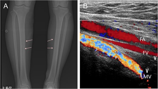 Radiograph showed bone cortex hypertrophy (arrow) of the lower limbs (A). Dilation of superficial vein in bilateral lower limbs, retrograde flow of bilateral great saphenous vein and persistence of the lateral marginal vein were detected by ultrasonography. FA, femoral artery; FV, femoral vein; LMV, lateral marginal vein (B).