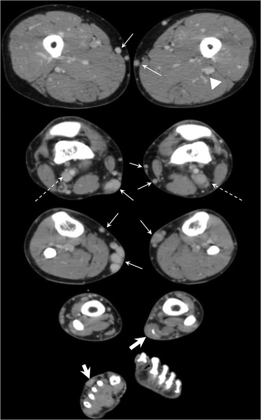 CT venography revealed dilation of superficial veins in bilateral lower limbs (arrows), persistent with the bilateral lateral marginal veins (dotted arrows) and left sciatic vein (arrow head) and soft tissue density area centered in dorsal subcutaneous fat layer of right foot and left lower limb (thick arrows).