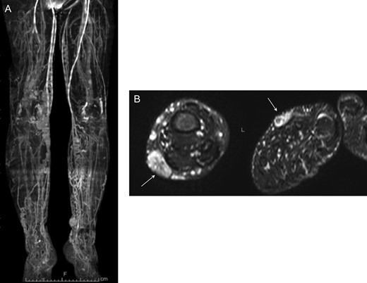 MR venography confirmed dilation of superficial lower limb veins (A). STIR MR imaging detected high signal intensity mass (arrows) indicating multiple lymphovascular malformation in subcutaneous fat layer of bilateral feet (B).