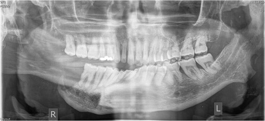 Dental panoramic tomograph from 2016 showing extensive bone loss of the right mandible, left coronoid process and ramus.