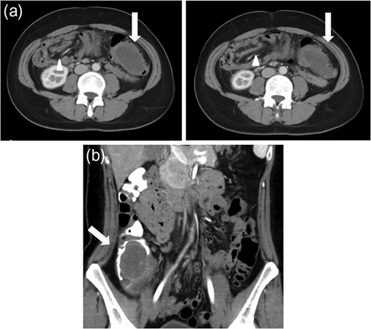 (a) Axial CT scan of the abdomen showing a mass (arrow) filling the transverse colon with accompanying mesenteric fat and vessels (arrowhead) within the lumen. (b) Coronal CT scan after reduction by colonoscopy. A low-density mass (arrow) is pushed back into the caecum.