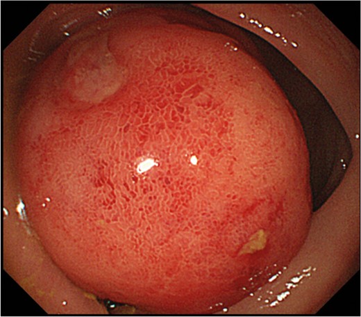 Endoscopic examination showing a pedunculated lesion with the base near the ileocecal valve, occupying most of the transverse colic lumen.