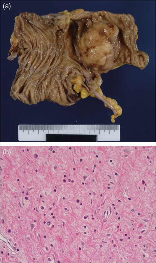 a) The bowel wall is cut away, showing the mass emanating from the ileum. (b) The tumour is composed of bland spindle cells with a fibromyxoid background, containing numerous eosinophils.