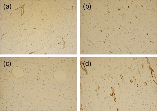 The spindle cells are negatively stained for CD34 (a), C-kit (b), S100 (c) and smooth muscle actin (d).