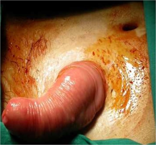 Incision on the prolapsed bowel.