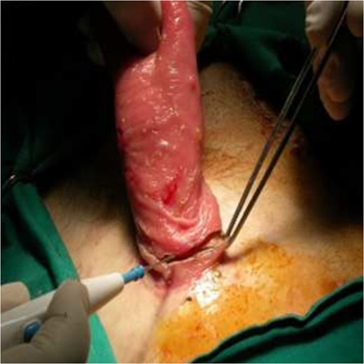 Prolapsed colon dissected with vessels ligation.