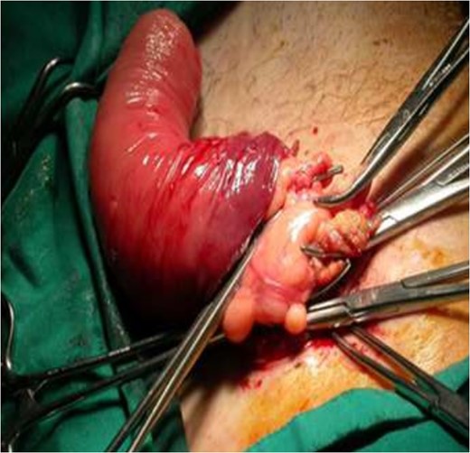 Prolapsed colon was removed and inner colon part was fixed on the abdominal wall.