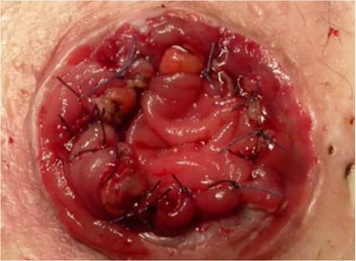 New stoma.