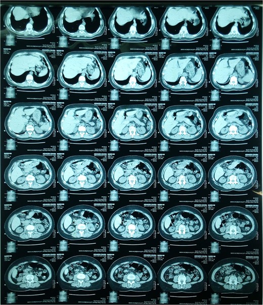 Abdominopelvic spiral CT scan of the patient before surgery.