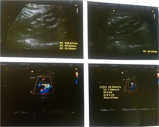 Color Doppler ultrasound of the transplanted kidney 2 months after surgery.